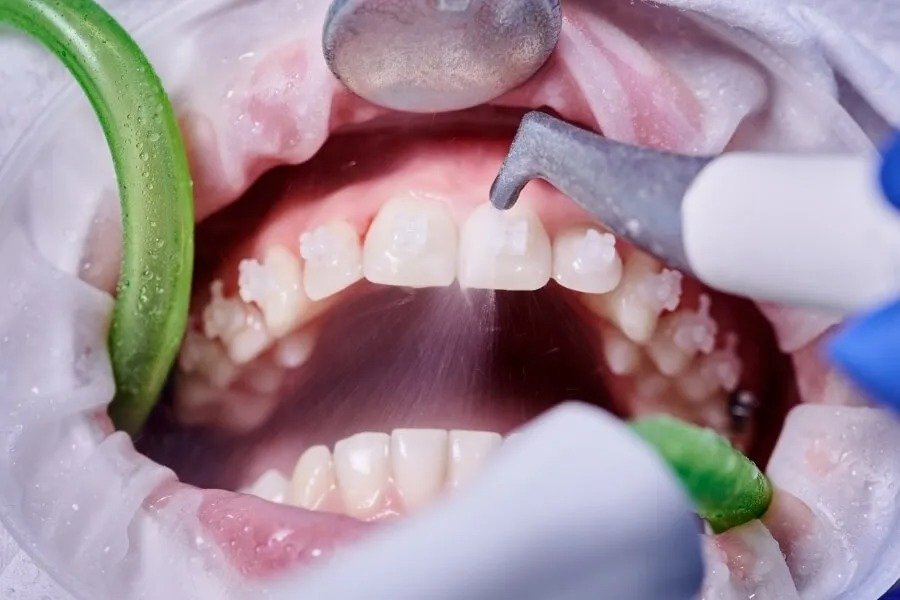 How much is a dental cleaning without insurance