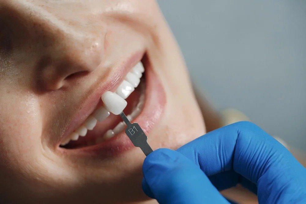 Teeth Bonding